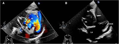 Case report: Use of three-dimensional technology in criss-cross heart with double outlet right ventricle